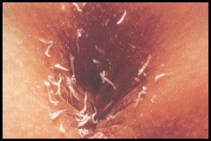 Pinworm infection