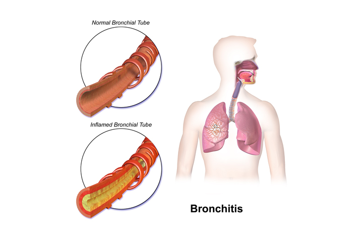 Acute bronchitis, Kəskin bronxit
